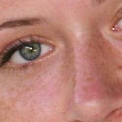Remove Freckles